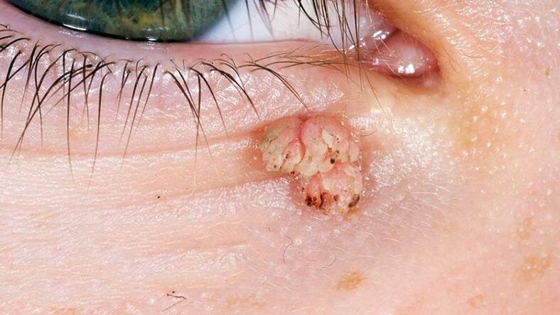 hanging papilloma in the eye