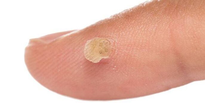 warts on a finger how to treat
