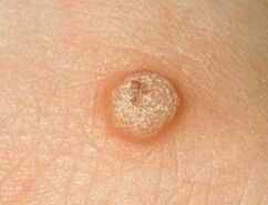 vulgaris warts on the skin