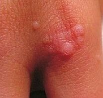 warts in the hands