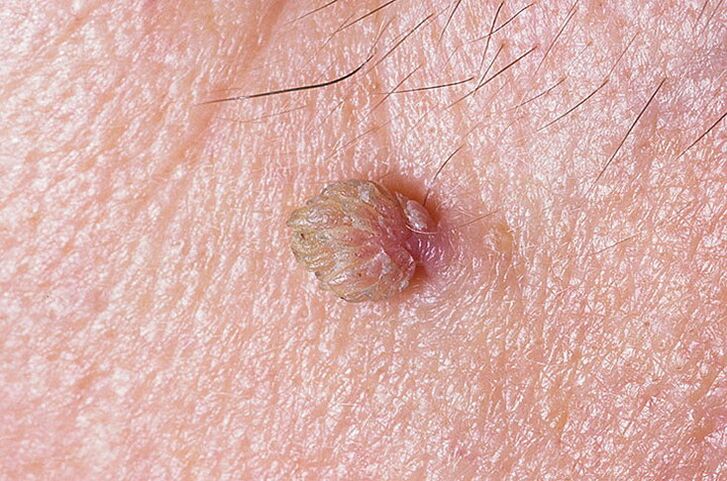 There are many ways to remove warts on the skin