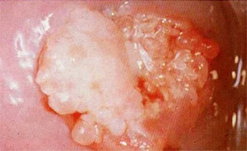 Candoid from the cervix