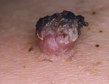papilloma