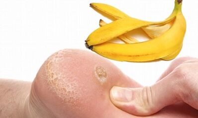 Banana peel to treat a planted wart