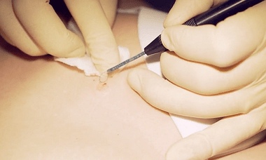 Surgical removal of planar wart