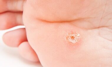 Why do the planta warts appear