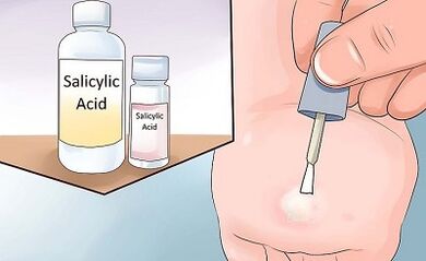 How to get rid of the popular path of papillomas