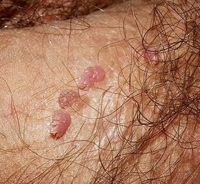 Papillomas in the penis