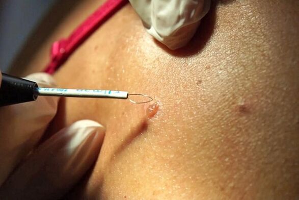 Removal of papillomas using the radio wave method