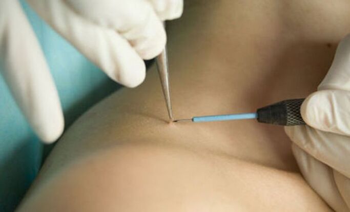 application of radio wave therapy