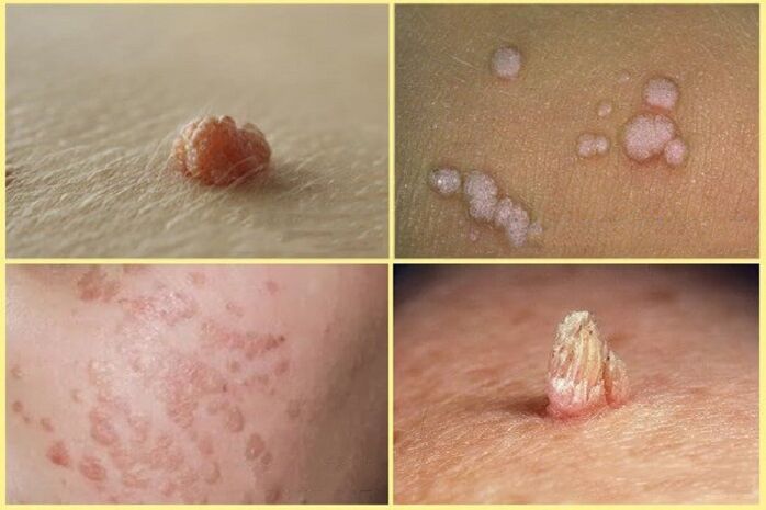 type warts