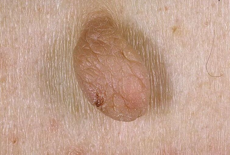 what warts and papillomas look like