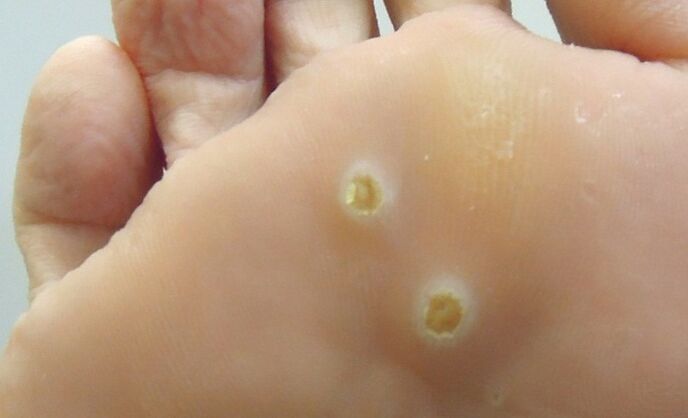 plantar papillomas on the feet