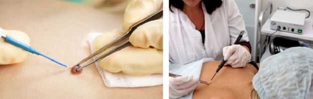 electrocoagulation as a way to remove papillomas