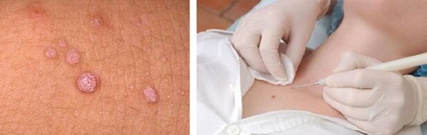 professional removal of papillomas on the body