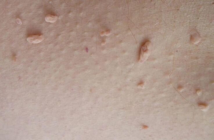 filiform papillomas on the skin