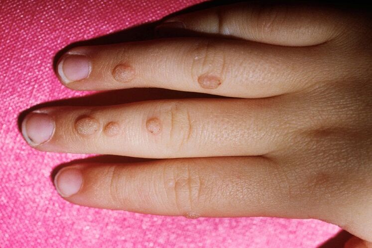 vulgar warts on the fingers