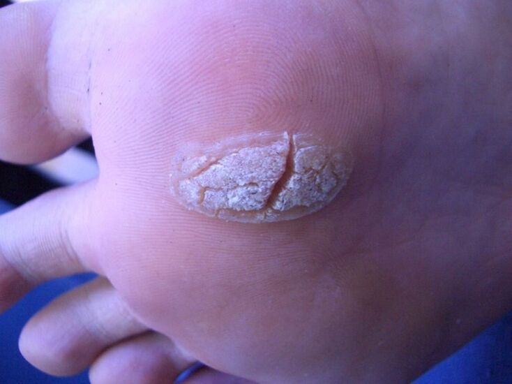 wart on the skin of the leg