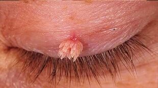 Pointed warts on the eyelid