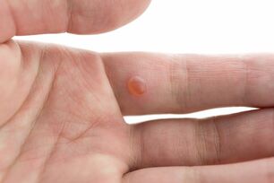 effective treatments for warts