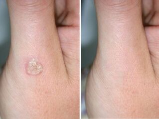 Before and after wart removal